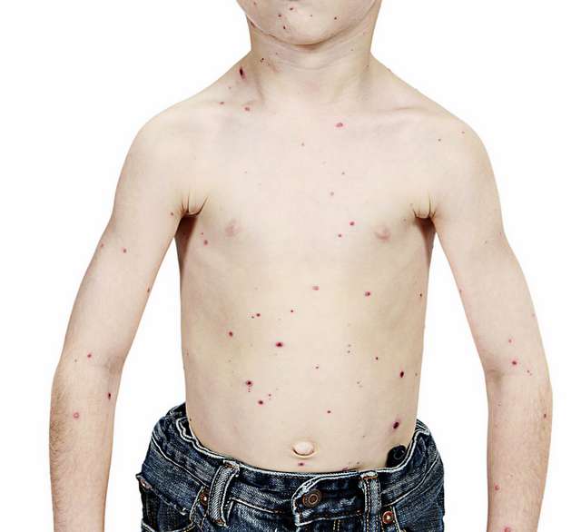 Chickenpox parties popular despite vaccine