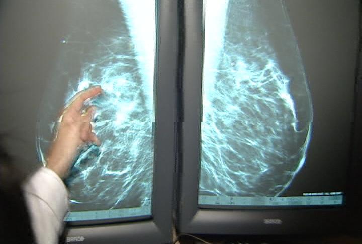 Utah women skipping yearly mammograms