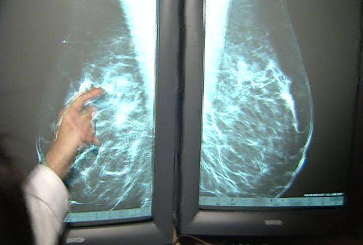 Huntsman cancer researchers bring new hope to breast cancer fight