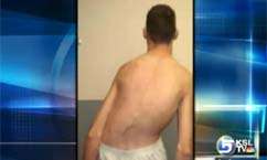 U of U Participates in Scoliosis Research