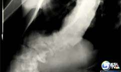 U of U Participates in Scoliosis Research