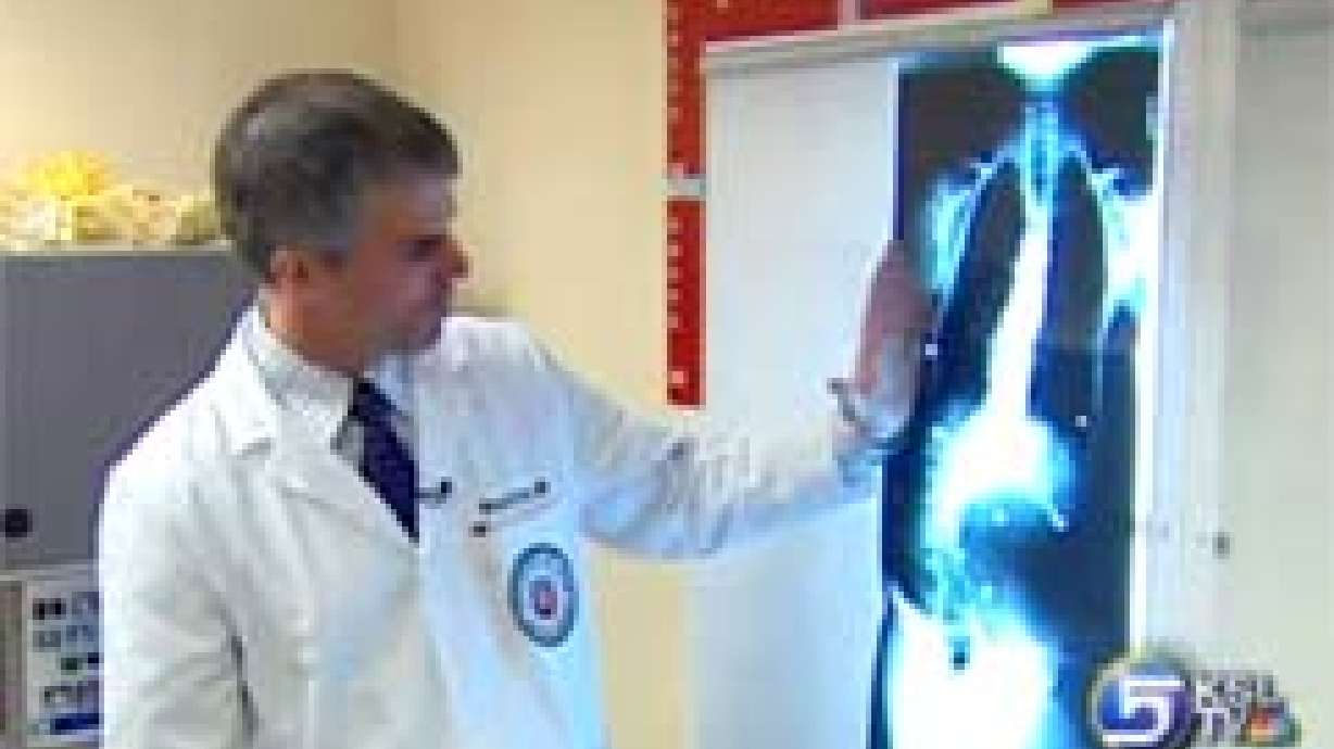 U of U Participates in Scoliosis Research