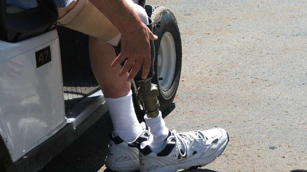 Bill would require insurers to cover prosthetics