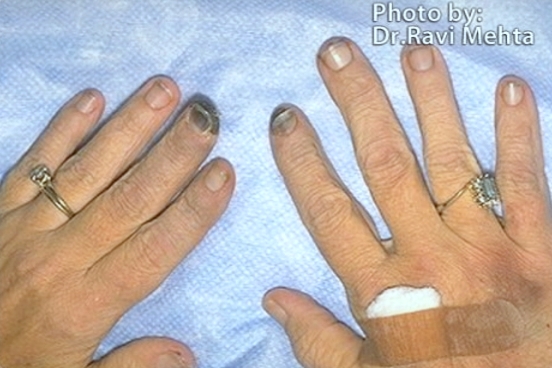 Utah doctor explains rare disease responsible for Larry Miller's death