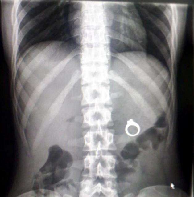 The X-ray showing the ring inside Kaitlin.