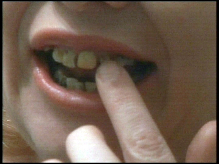 Woman who can't afford dentures uses Superglue instead