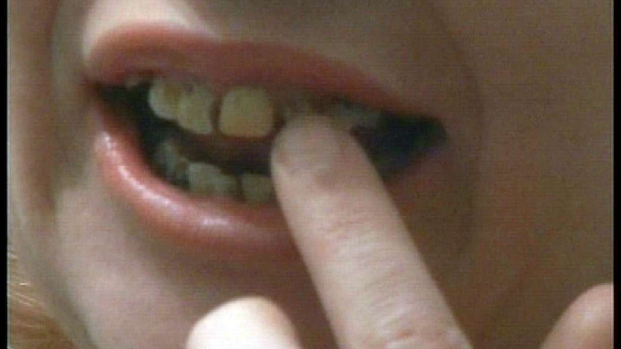 Woman who can't afford dentures uses Superglue instead